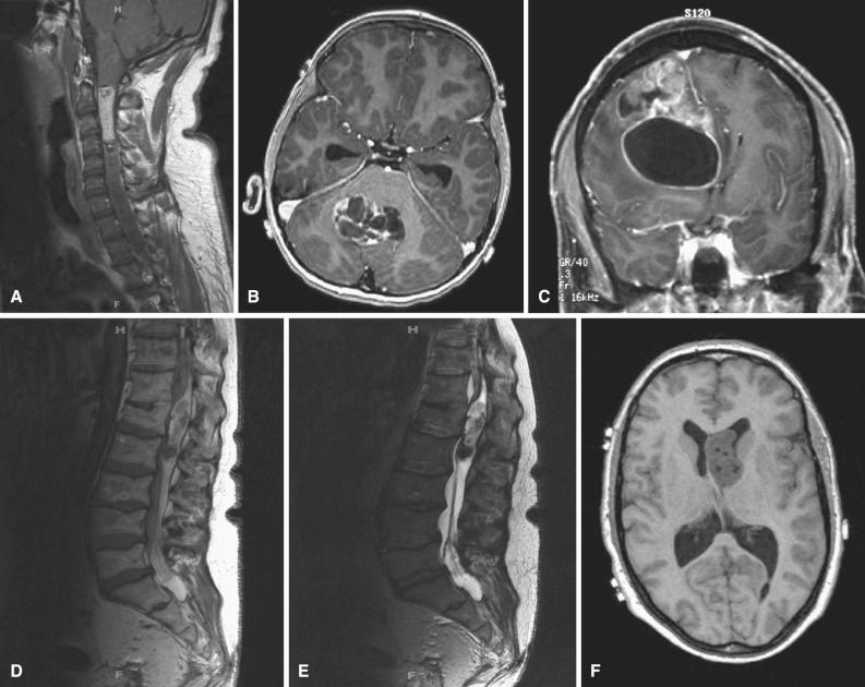 Fig. 8.1, (A) Spinal ependymoma. T1-weighted postcontrast magnetic resonance image (MRI) showing uniformly enhancing intramedullary cervical spinal tumor. The low-density regions below are consistent with an associated syrinx. (B) Intracranial ependymoma. T1-weighted postcontrast MRI showing well-demarcated fourth-ventricular tumor with heterogeneous enhancement and cyst formation. (C) Supratentorial ependymoma. Contrast-enhanced T1-weighted MRI showing a large partially cystic intraparenchymal mass in the right frontal lobe. (D, E) Myxopapillary ependymoma. Classic cauda equina/filum terminale location with heterogeneous mass containing hyperintense foci on both T1-weighted (D) and T2-weighted (E) MR images. (F) Subependymoma. T1-weighted MRI showing sharply demarcated nodular lesion within the lateral ventricle.