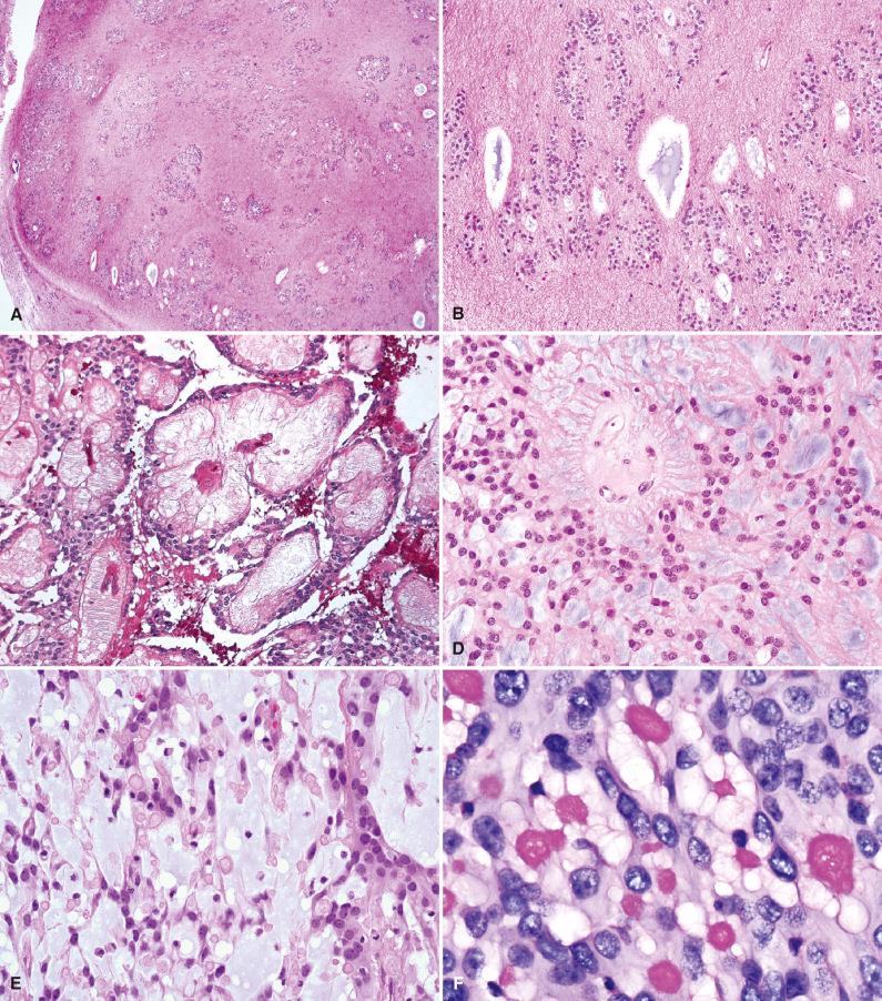 Fig. 8.2, Histologic features of grade I ependymal tumors. (A, B) Subependymoma. Hypocellular, vaguely lobulated neoplasm with clustered cytologically bland nuclei, densely fibrillar background, and microcysts. (C, D) Myxopapillary ependymoma. Papillary and solid structures containing abundant myxoid stroma and radially arranged elongated glial processes surrounding hyalinized blood vessels. (E, F) Myxopapillary ependymoma. Collagen balls on H & E (E) and PAS (F) stains.