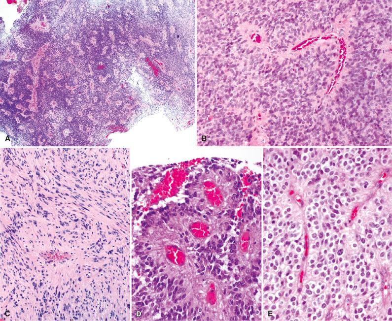 Fig. 8.4, Histologic features of WHO grade II ependymoma variants. (A, B) This ependymoma is hypercellular but lacks endothelial proliferation and increased mitotic activity. (C) Tanycytic ependymoma. Fascicular pattern of elongated spindle cells with less conspicuous pseudorosettes. (D) Papillary ependymoma. Papillary structures contain gliofibrillary “stroma.” (E) Clear cell ependymoma. Sheets of cells with abundant clear cytoplasm interrupted by vague perivascular pseudorosettes.