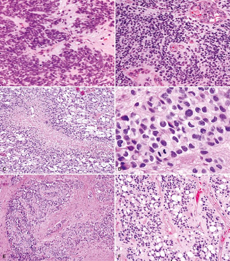 Fig. 8.5, Histologic features of anaplastic ependymoma (WHO grade III) and unusual variant ependymoma patterns. (A) Hypercellular anaplastic ependymoma with numerous mitotic figures. (B) Anaplastic ependymoma showing abundant microvascular proliferation. (C) Anaplastic ependymoma with a focus of palisading necrosis. (D) Anaplastic ependymoma showing increased nuclear pleomorphism and mitotic activity. (E) Anaplastic ependymoma with evidence of a finger-like focus of microinvasion into adjacent CNS parenchyma. (F) Signet ring pattern. Ependymoma with abundant signet ring cells, wherein the nucleus is displaced to the periphery by a large clear vacuole. The latter likely represents large intracytoplasmic lumina. (G) Sclerotic pattern. Focus of dense fibrosis within an ependymoma. The atrophic epithelioid tumor cells are hard to recognize as glial. (H) Lipidized pattern. Ependymoma with extensive lipidization resembling foci of lipoma. Classic ependymal cytology with perivascular pseudorosettes is seen at the top of the image.