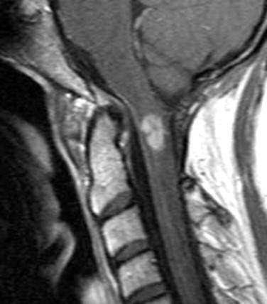 Fig 1, Ependymoma. The MRI shows a contrast-enhancing tumor within the cervical spinal cord.