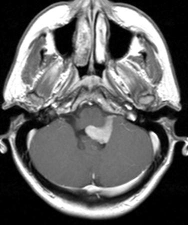 Fig 2, Ependymoma. This contrast-enhancing fourth ventricular tumor focally extends into the foramen of Luschka ( right ).