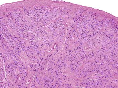 Fig 3, Ependymoma. Low-magnification view showing a sharp demarcation between the tumor and adjacent neural tissue along the top of the image.