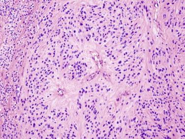 Fig 4, Ependymoma. These tumors display a rather uniform appearance with perivascular pseudorosettes as a distinctive feature that is usually present.