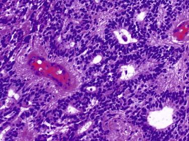 Fig 5, Ependymoma. Some tumors may form ependymal canal-like structures or have ependymal rosettes.