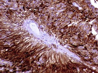 Fig 6, Ependymoma. GFAP immunoreactivity is particularly evident in tapering perivascular tumor cell processes.