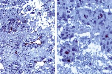 Fig 7, Ependymoma. EMA is typically reactive along the luminal borders of ependymal canals ( left ) and rosette-like structures ( right ).