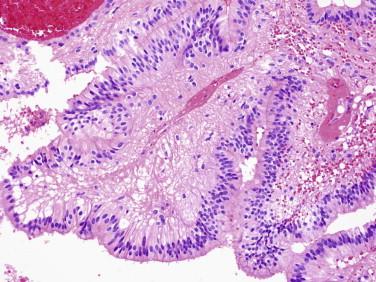 Fig 8, Papillary ependymoma. This variant forms linear epithelial-like surfaces along the border with CSF. Pseudopapillary structures may be seen in other examples.