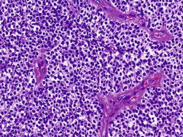 Fig 9, Clear cell ependymoma. This rare supratentorial variant maintains a sharply circumscribed border with adjacent brain tissue and is an important mimic of oligodendroglioma.