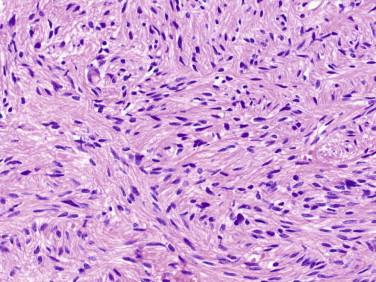 Fig 10, Tanycytic ependymoma. Such tumors show no ependymal rosettes, and perivascular pseudorosettes are subtle findings. This variant is an important mimic of astrocytoma in the spinal cord. Tanycytic ependymomas are typically well demarcated from the adjacent cord.