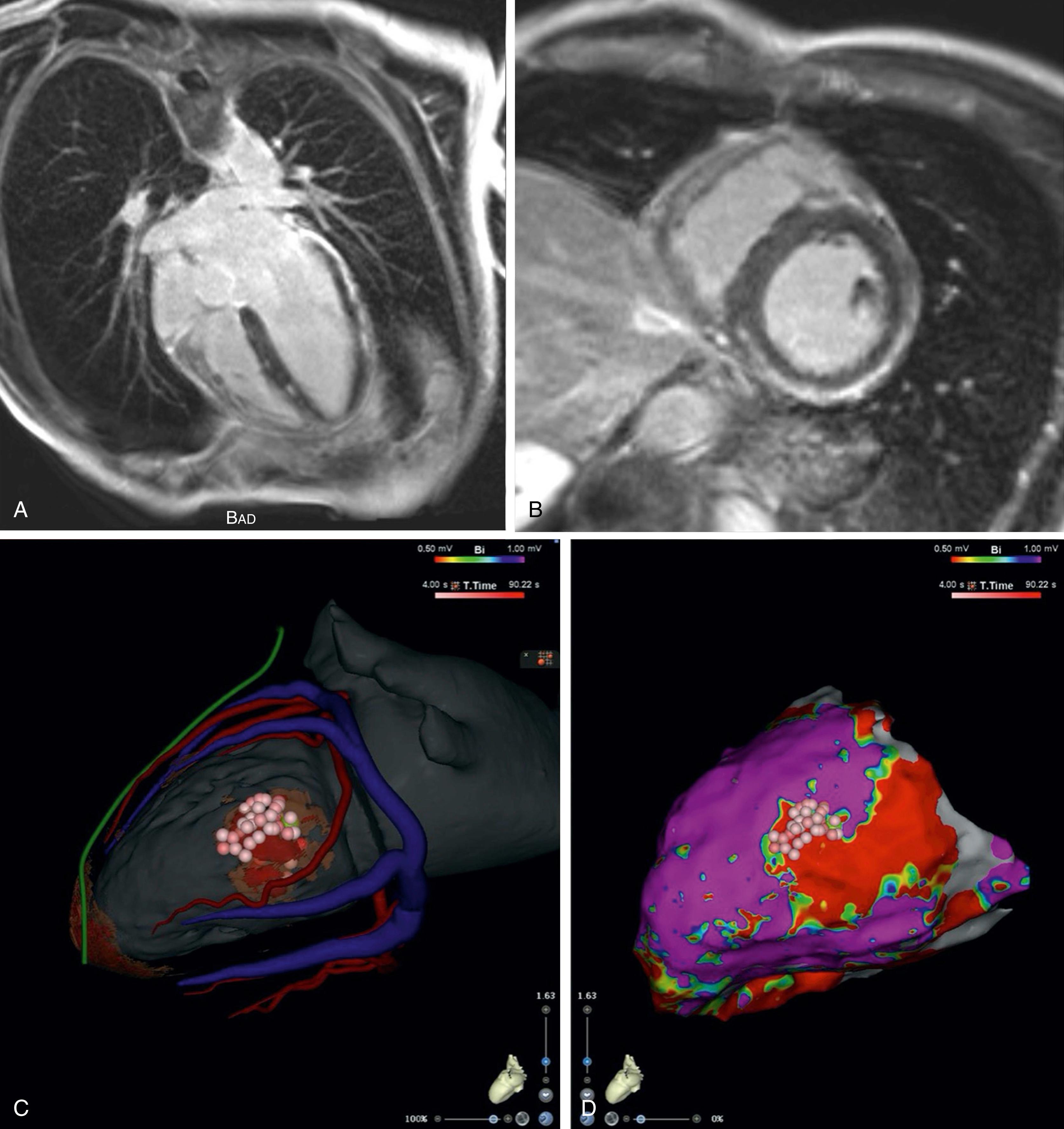 Fig. 134.3, (A–B) Magnetic resonance image showing an epicardial area of late gadolinium enhancement from postmyocarditis scar in the basolateral left ventricle. (C–D) Findings from another patient with postmyocarditis lateral scar. (C) Computed tomography reconstruction with scar and epicardial ablation sites ( pink and red tags ; arteries in red , coronary sinus in blue , phrenic nerve in green ). (D) Epicardial voltage map with the ablation sites.