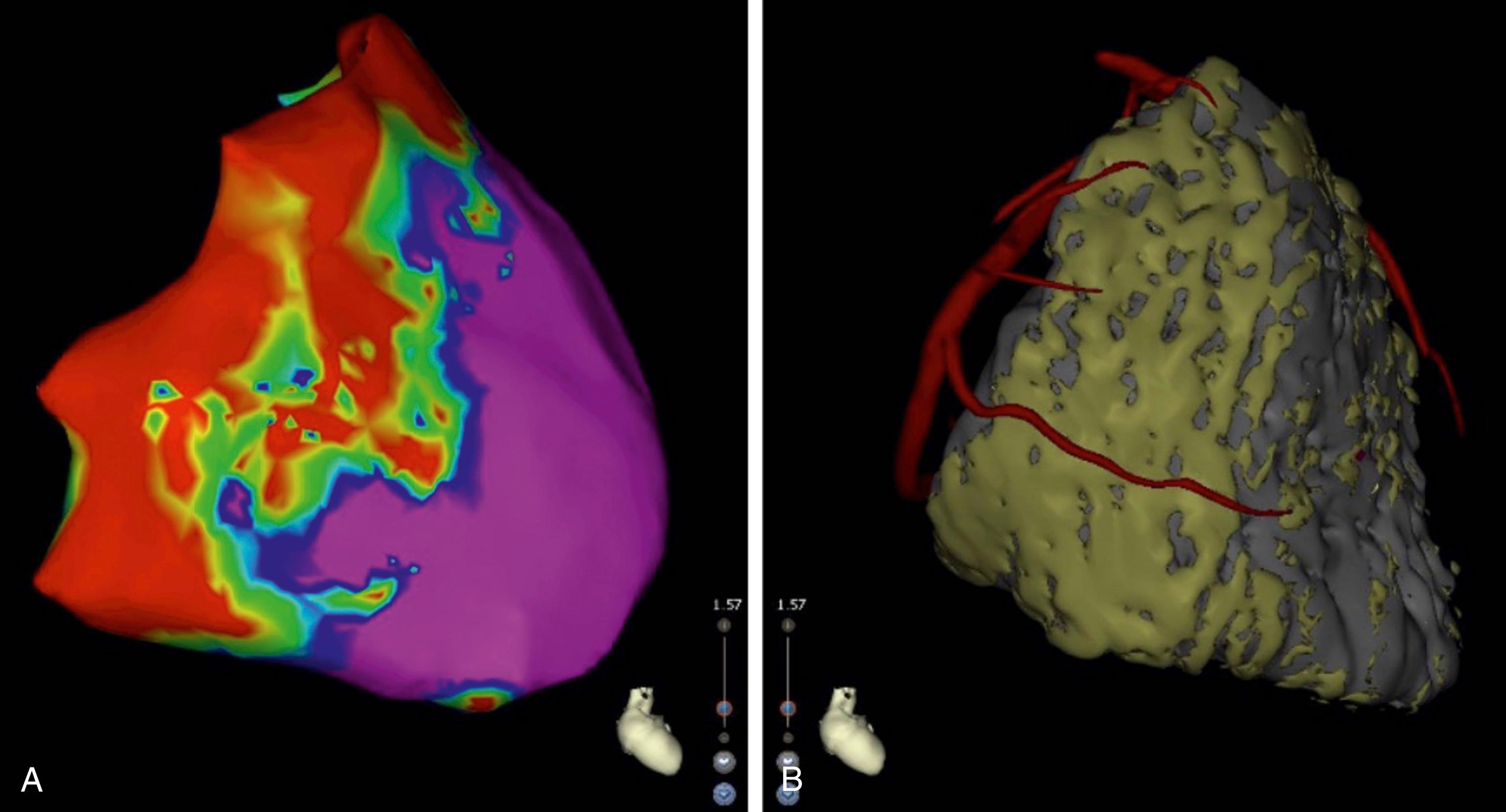 Fig. 134.4, (A) Typical arrhythmogenic right ventricular cardiomyopathy voltage map with basal and latero-tricuspid annulus scar ( red , yellow, green ) well correlated to the fat on computed tomography scan imaging (B).