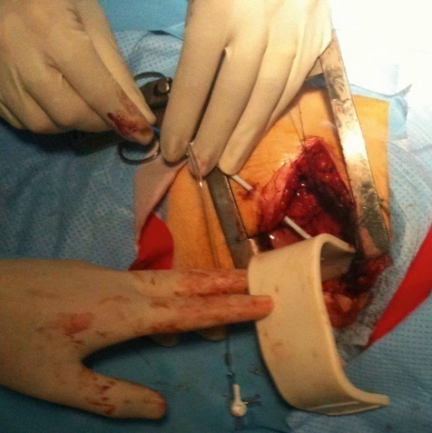 Fig. 134.5, Surgical intercostal approach through a lateral thoracotomy to access pericardium.