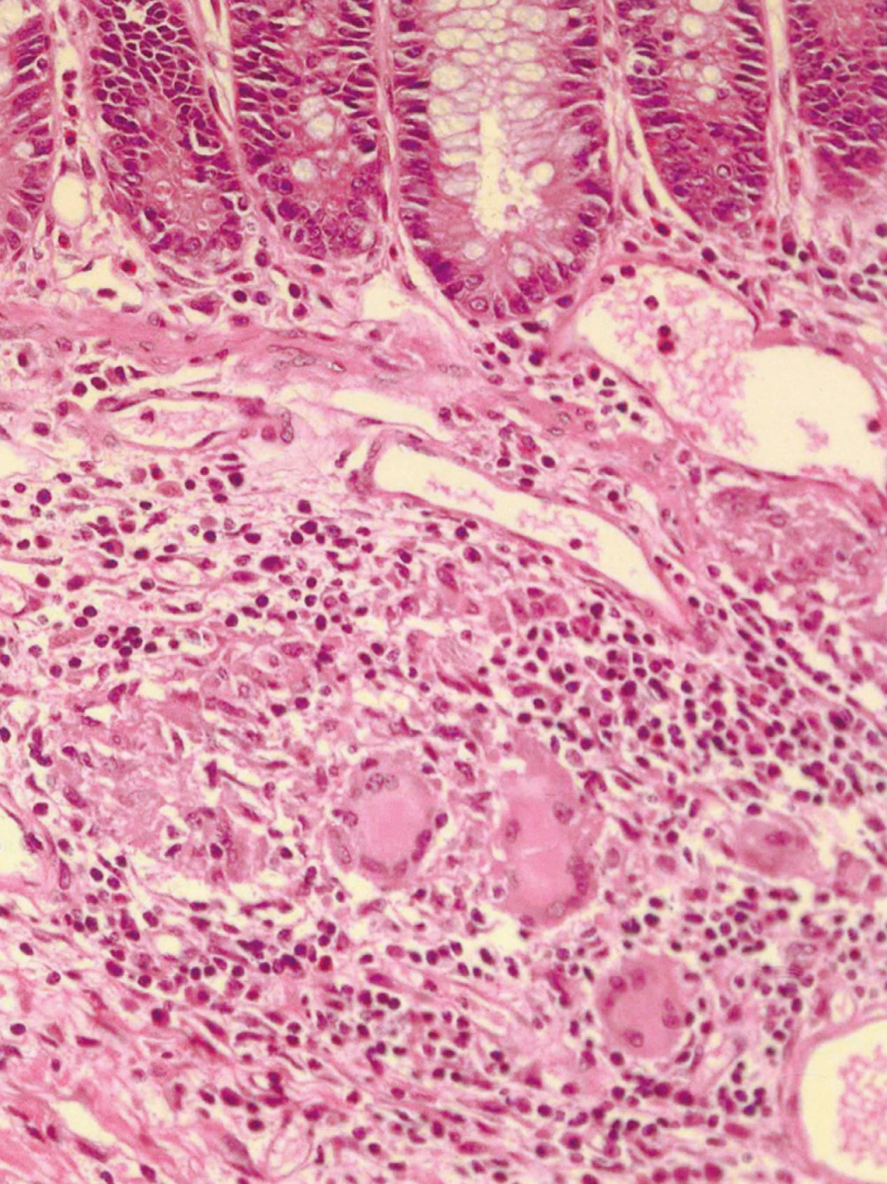 Fig. 115.5, Photomicrograph of a typical CD granuloma found in an endoscopic biopsy specimen. Note the loosely formed collection of cells, consisting of multinucleated giant cells (not always observed) and mononuclear cells, including T cells and epithelioid macrophages. Central caseation is not noted.