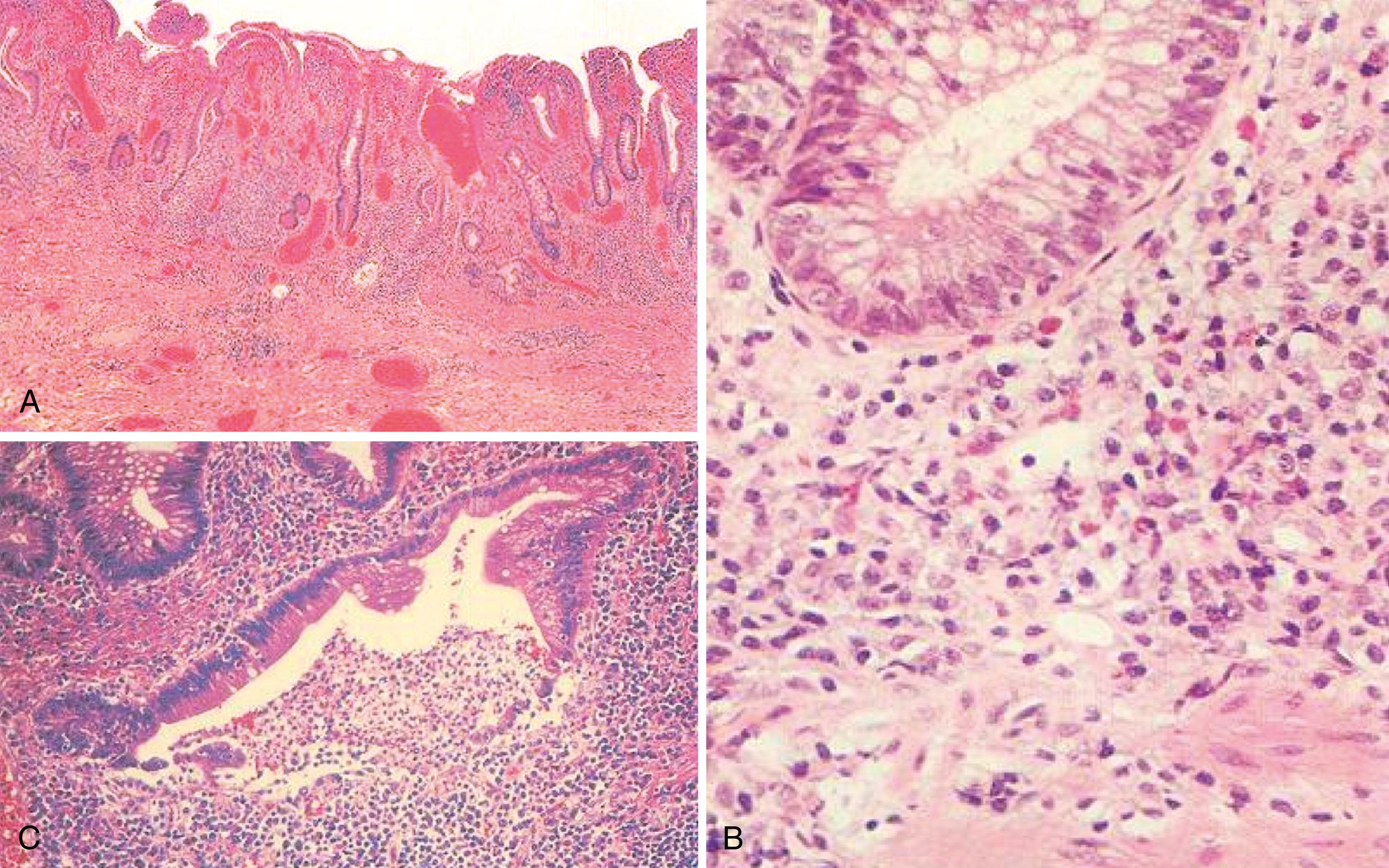 Fig. 115.7, Photomicrographs of a colonic biopsy specimen showing the histology of UC. A, Diffuse chronic inflammation of the lamina propria and crypt distortion are present. These features are important in differentiating UC from acute self-limited colitis. B, The base of a single distorted colonic crypt. There are many plasma cells between the crypt and the muscularis mucosae, another important finding that helps differentiate acute from chronic colitis. C, A single crypt abscess. The bottom of this distorted crypt has been destroyed by an aggregate of polymorphonuclear neutrophils. This finding is not specific for UC and may be seen in CD and other types of colitis.