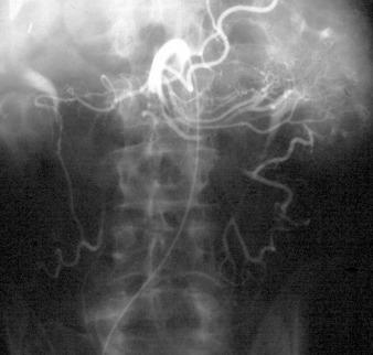 Fig. 25.2, Mesenteric Angiography Demonstrating Acute Mesenteric Emboli.