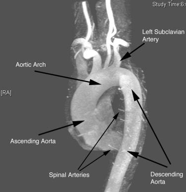 Fig. 35.1, Magnetic Resonance Angiography of the Thoracic Aorta.