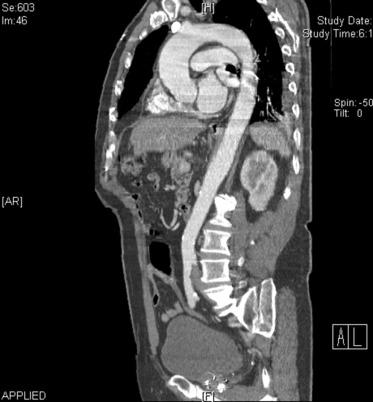 Fig. 35.2, Magnetic Resonance Angiogram of Ascending Aortic Aneurysm.