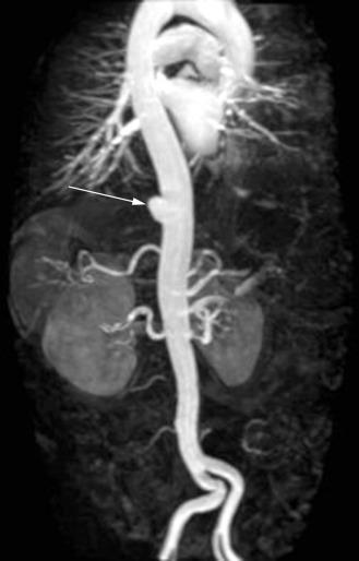 Fig. 35.3, Maximal Intensity Projection of Magnetic Resonance Image of Saccular Aneurysm.