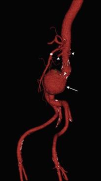 Fig. 35.4, 3-D Reconstruction of Computed Tomographic Angiogram of Infrarenal Abdominal Aortic Aneurysm.