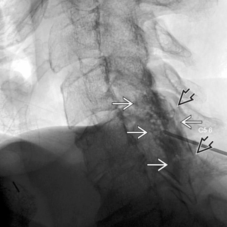 Cervical Epidurogram: Lateral View