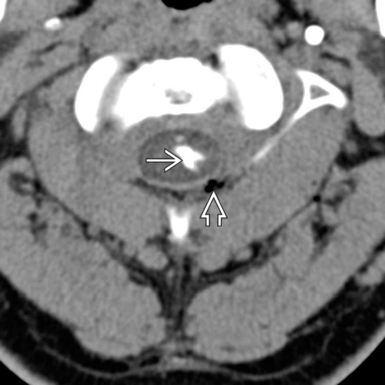 Complication: Cord Puncture