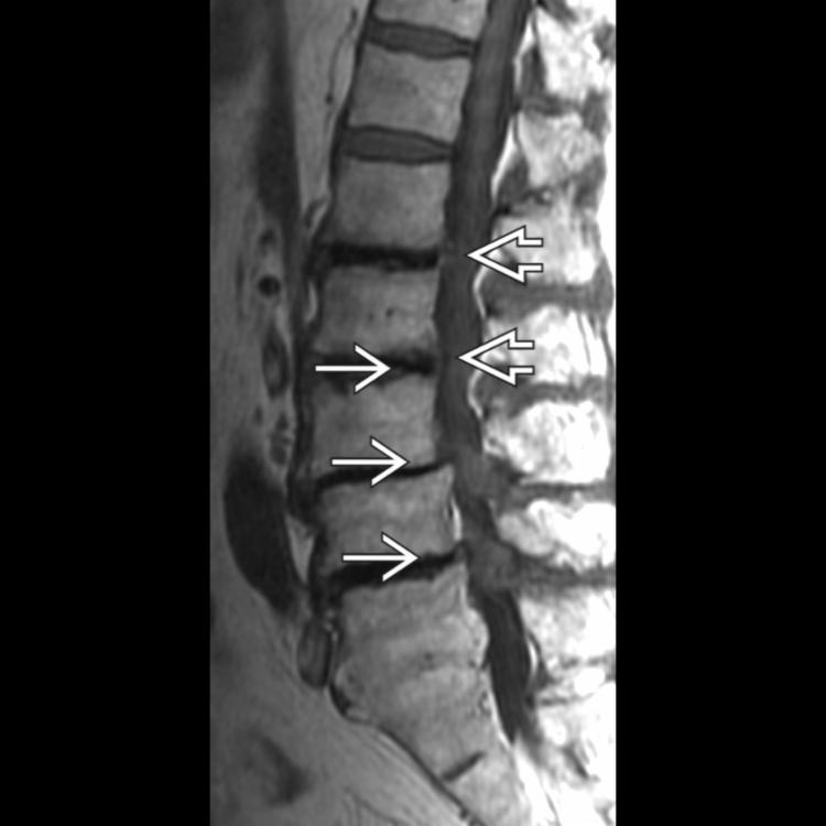 Severe Central Canal Stenosis