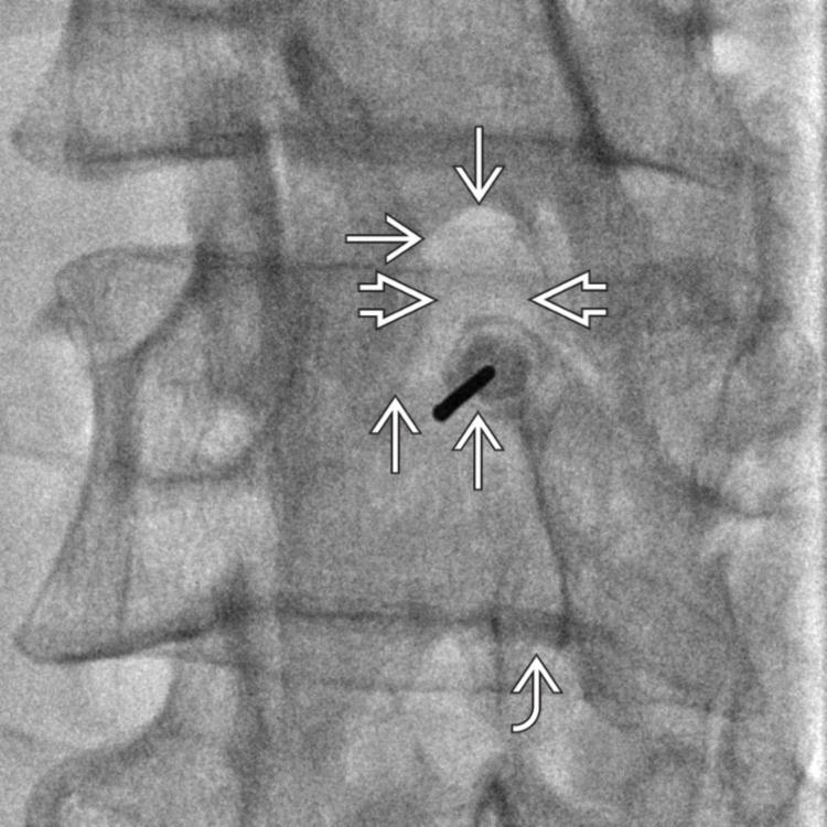 Needle Placement: Interlaminar ESI