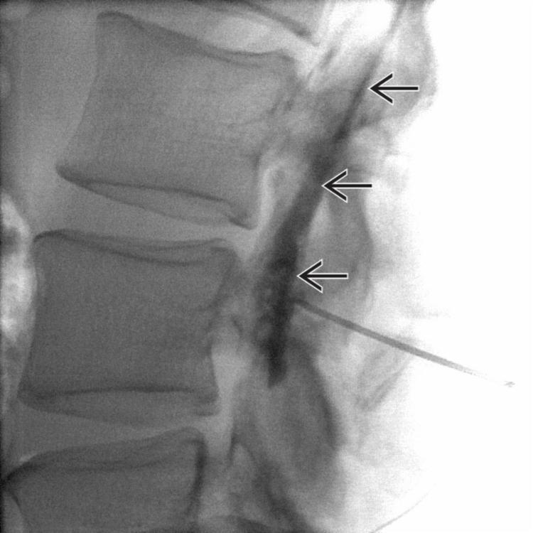 Contrast Spread in Dorsal Epidural Space