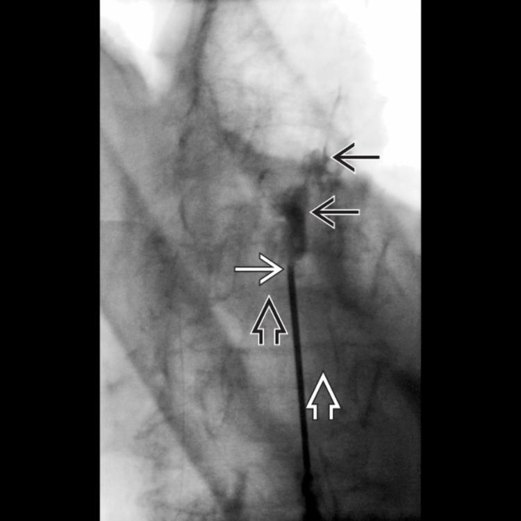 Frontal Oblique Epidurogram