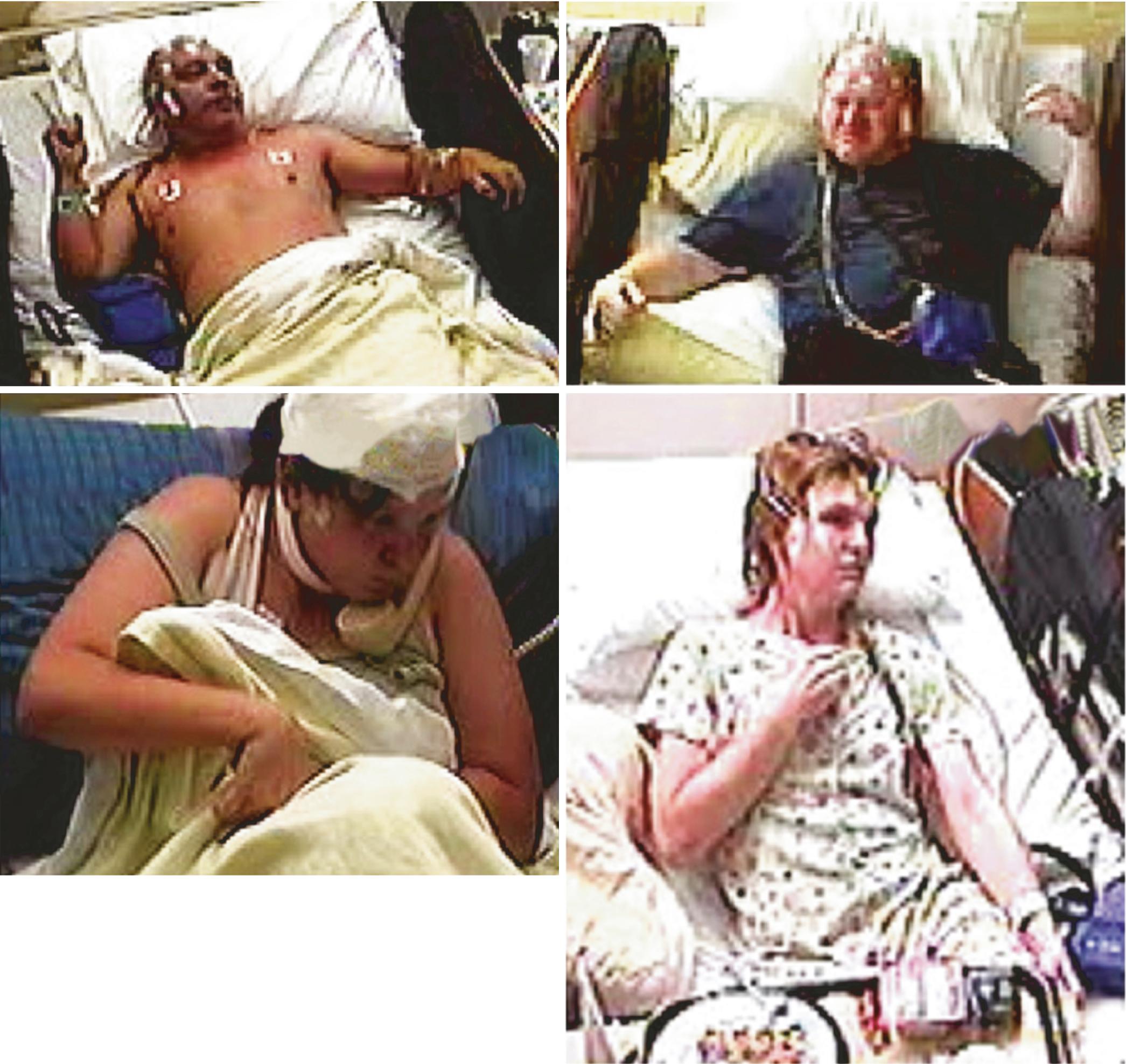 Fig. 100.2, Dystonic posturing (DP): variable pattern demonstrated in four patients with temporal lobe epilepsy. Left to right: top, right arm DP, left arm DP; bottom, right arm DP, right arm DP.