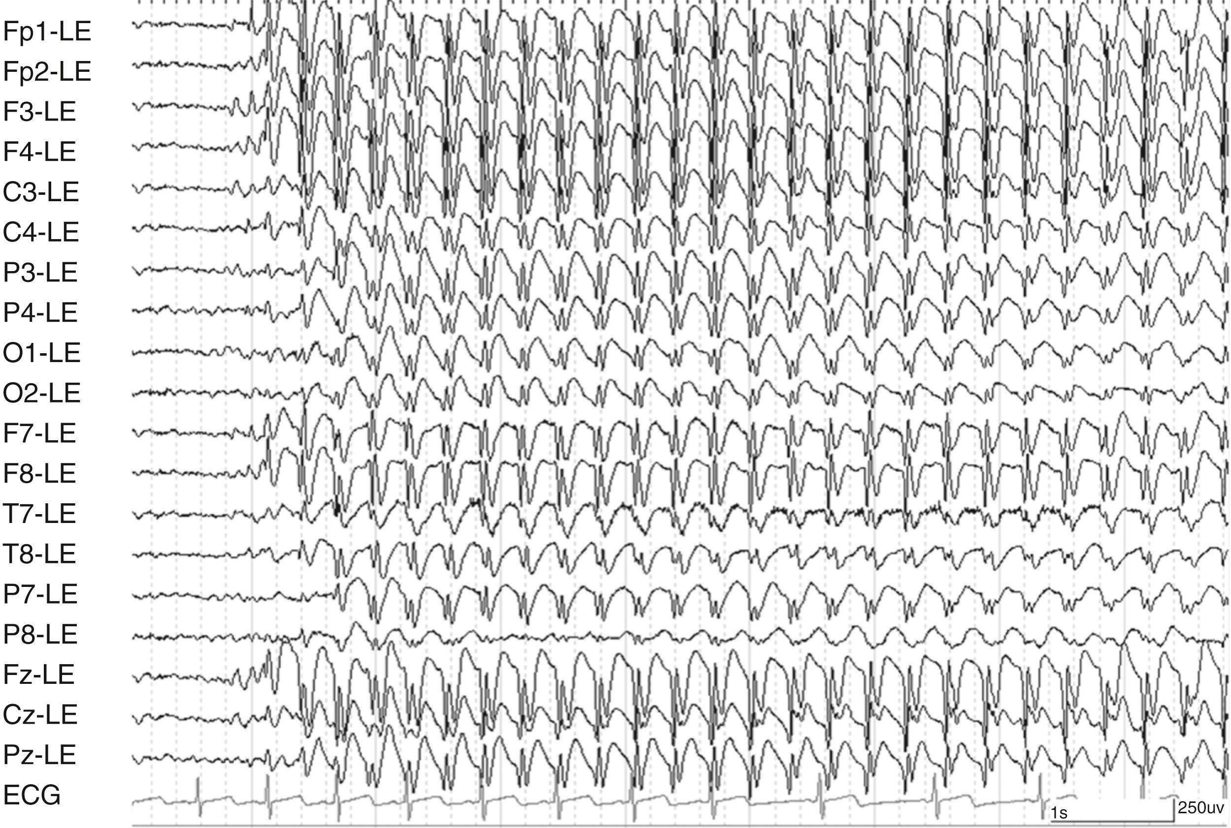 Fig. 100.5, Generalized absence seizure displayed with referential montage using linked ear reference. Spike-and-wave discharges are bifrontally predominant.