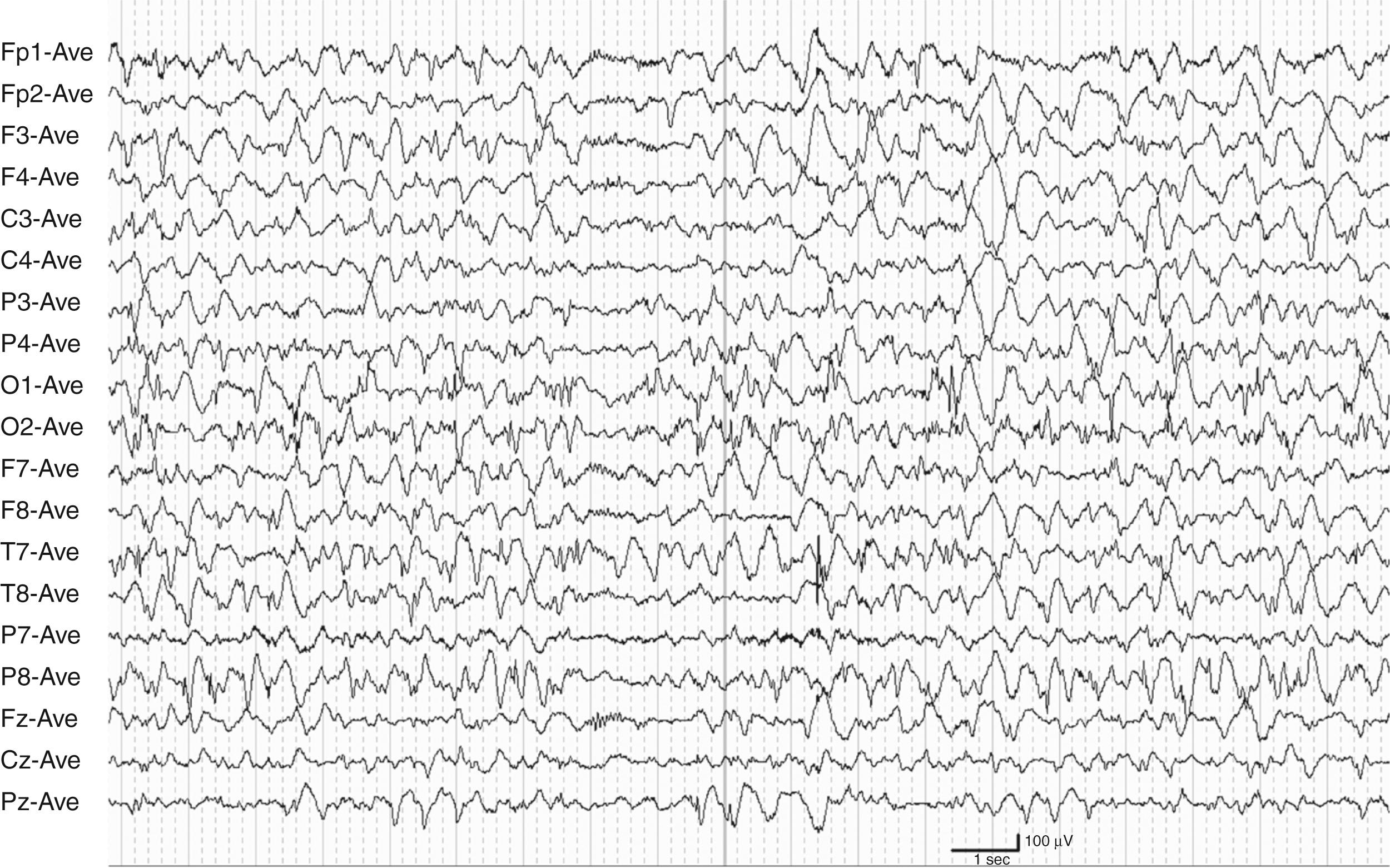 Fig. 100.7, Hypsarrhythmia pattern with disorganized high-voltage slow background activity, multifocal spikes and sharp waves, and a period of attenuation.