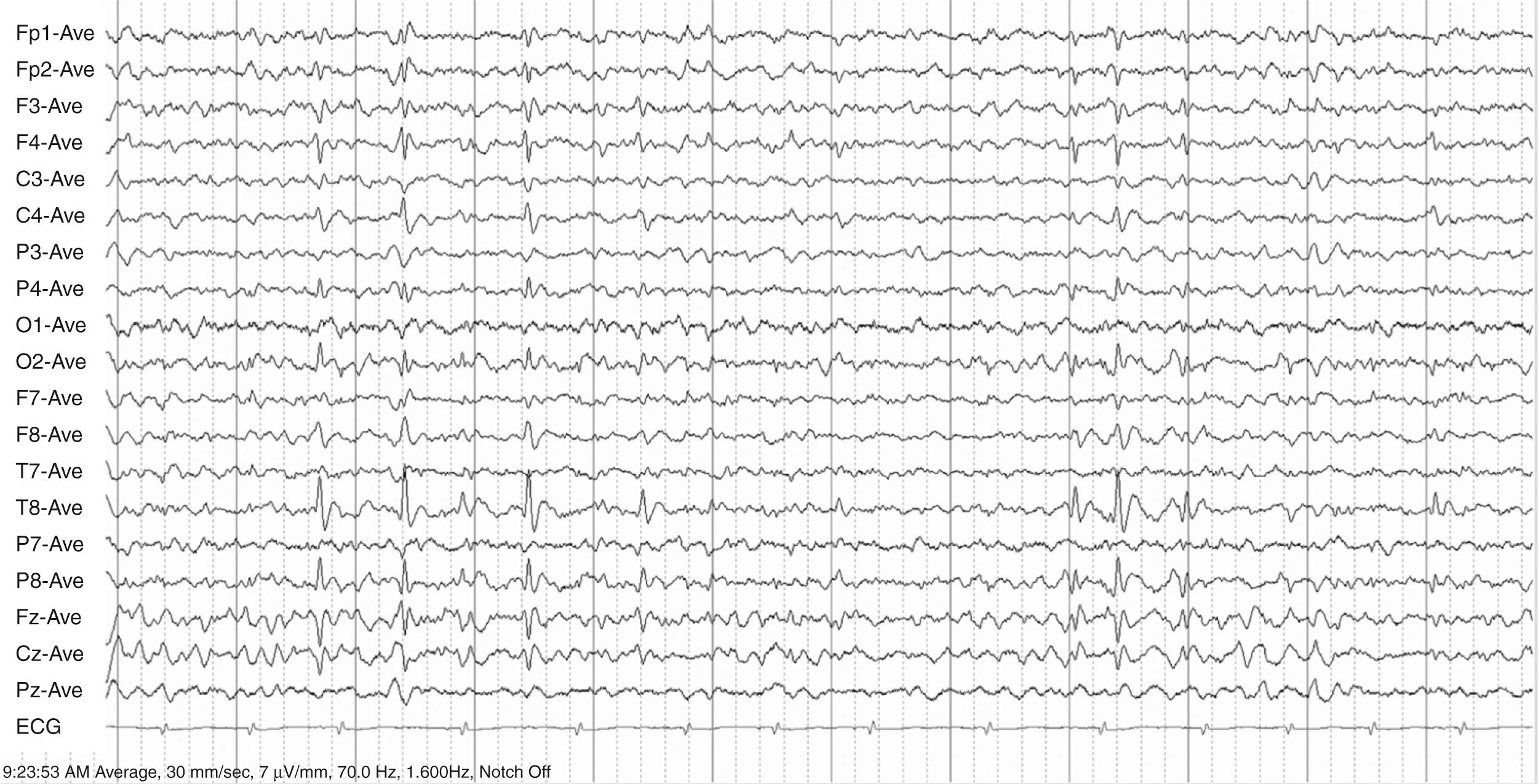 Fig. 100.9, Characteristic sleep electroencephalographic recording in patient with benign epilepsy with centrotemporal spikes, demonstrating frequent negative right midtemporal sharp waves (at T8 ) with field extending to right posterior temporal (P8) and right central (C4) regions. Note simultaneous positivity in bifrontal regions.