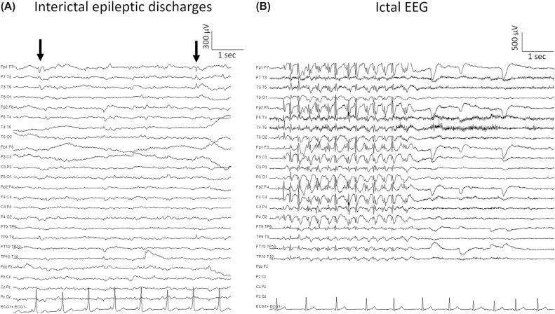 Figure 81.2, EEG in epilepsy: (A) focal interictal epileptic discharges ( arrows ) in left frontotemporal region; (B) ictal EEG showing a spike-and-wave discharge pattern during an absence seizure.