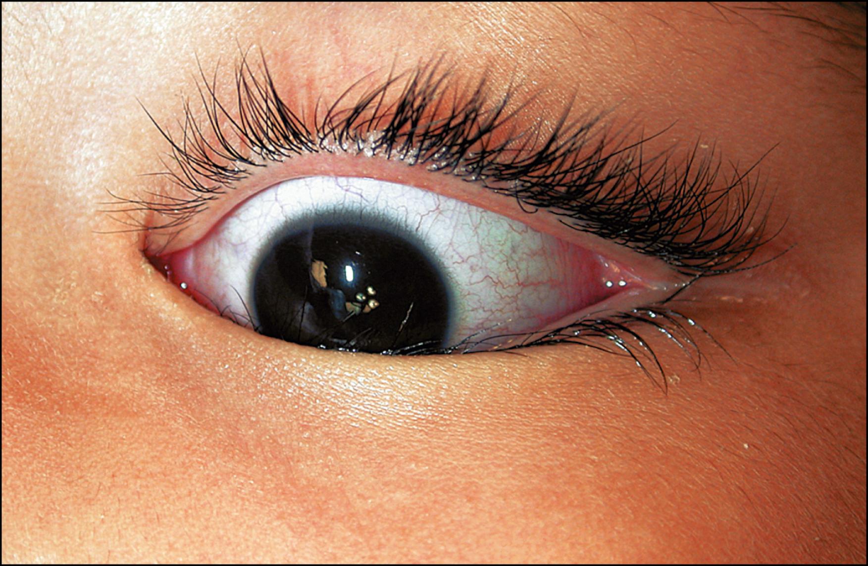 Fig. 35.1, Left lower eyelid epiblepharon causing the eyelashes to rotate in and rub against the cornea. This can cause chronic ocular irritation and overproduction of tears.
