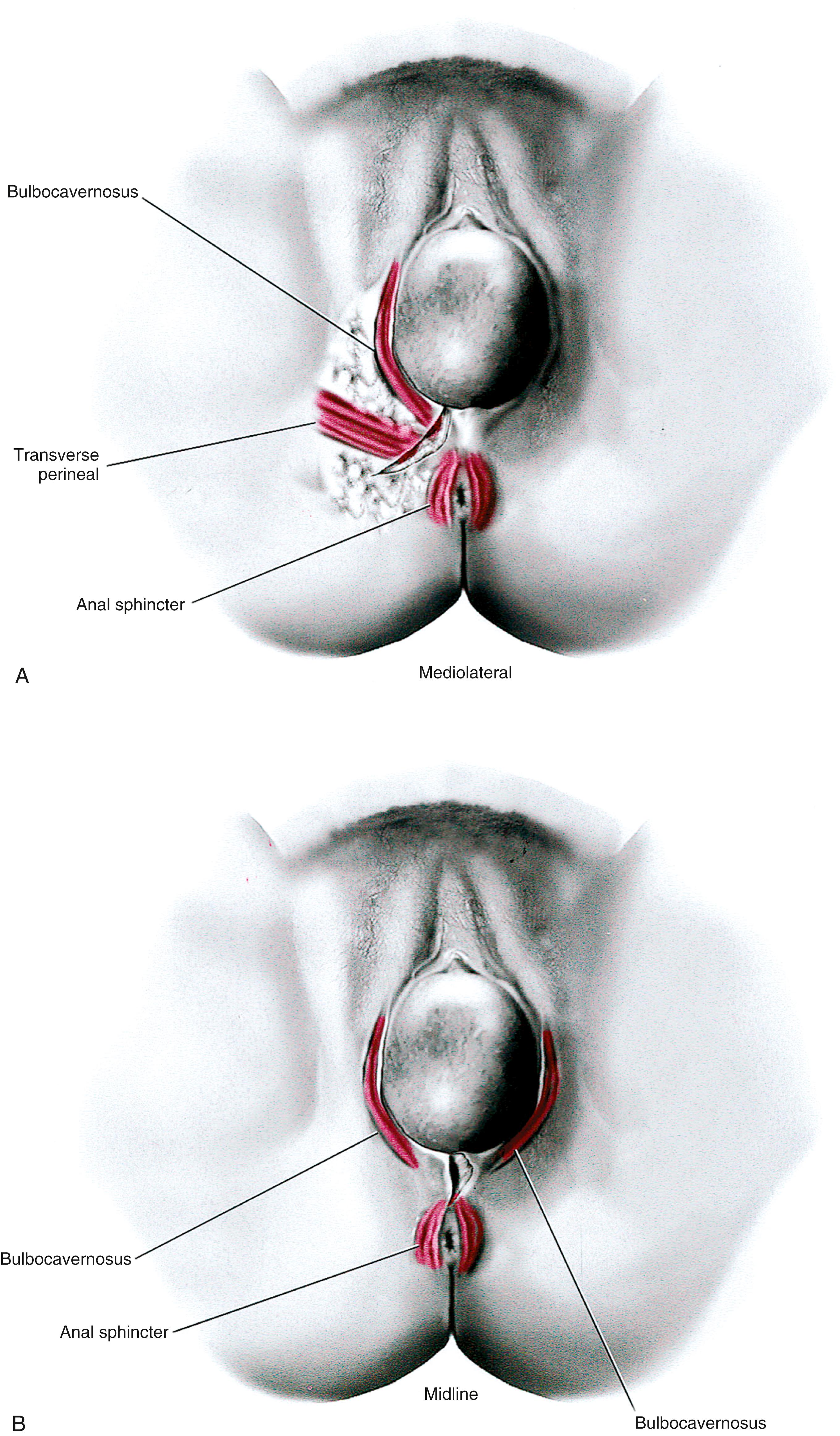 FIG. 78.1, The two types of episiotomy, which may be cut at the time of vaginal birth, are illustrated here. Key perineal muscles have been superimposed. A. Mediolateral approach. B. Midline approach.