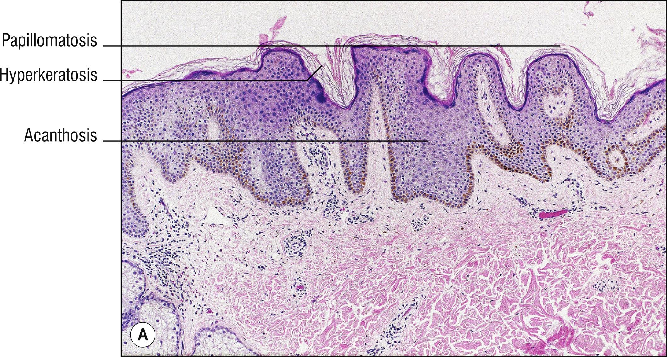 Fig. 18.1, A Epidermal nevus.