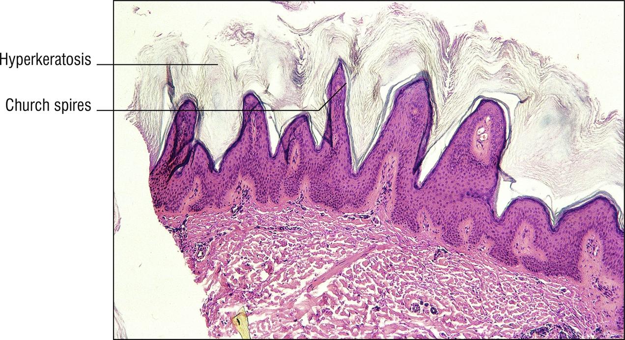 Fig. 18.3, Acrokeratosis verruciformis.