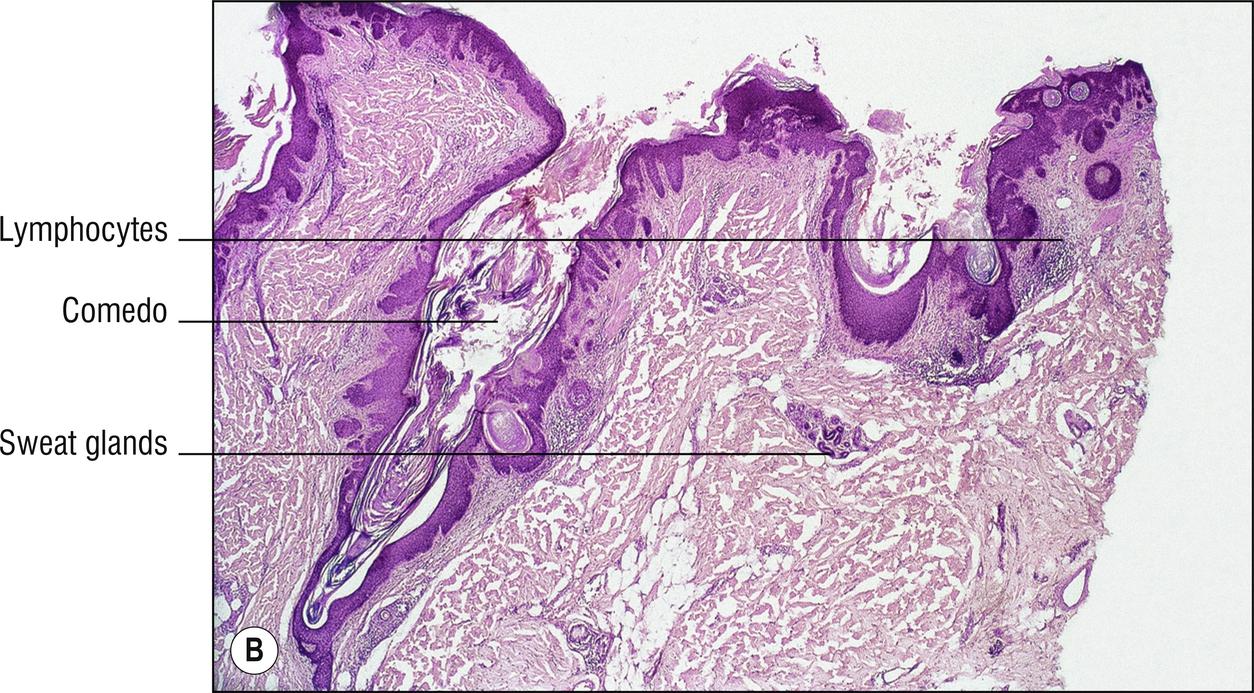 Fig. 18.1, B Nevus comedonicus.