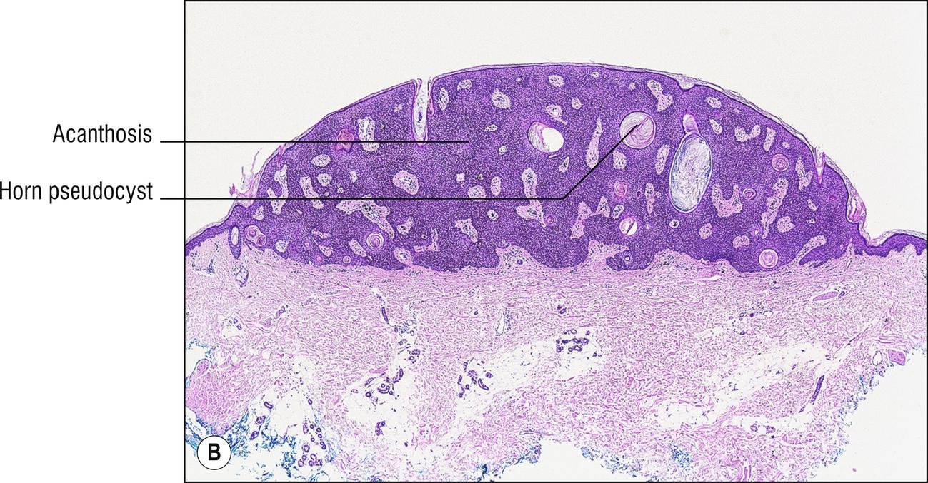 Fig. 18.2, B Seborrheic keratosis (acanthotic).