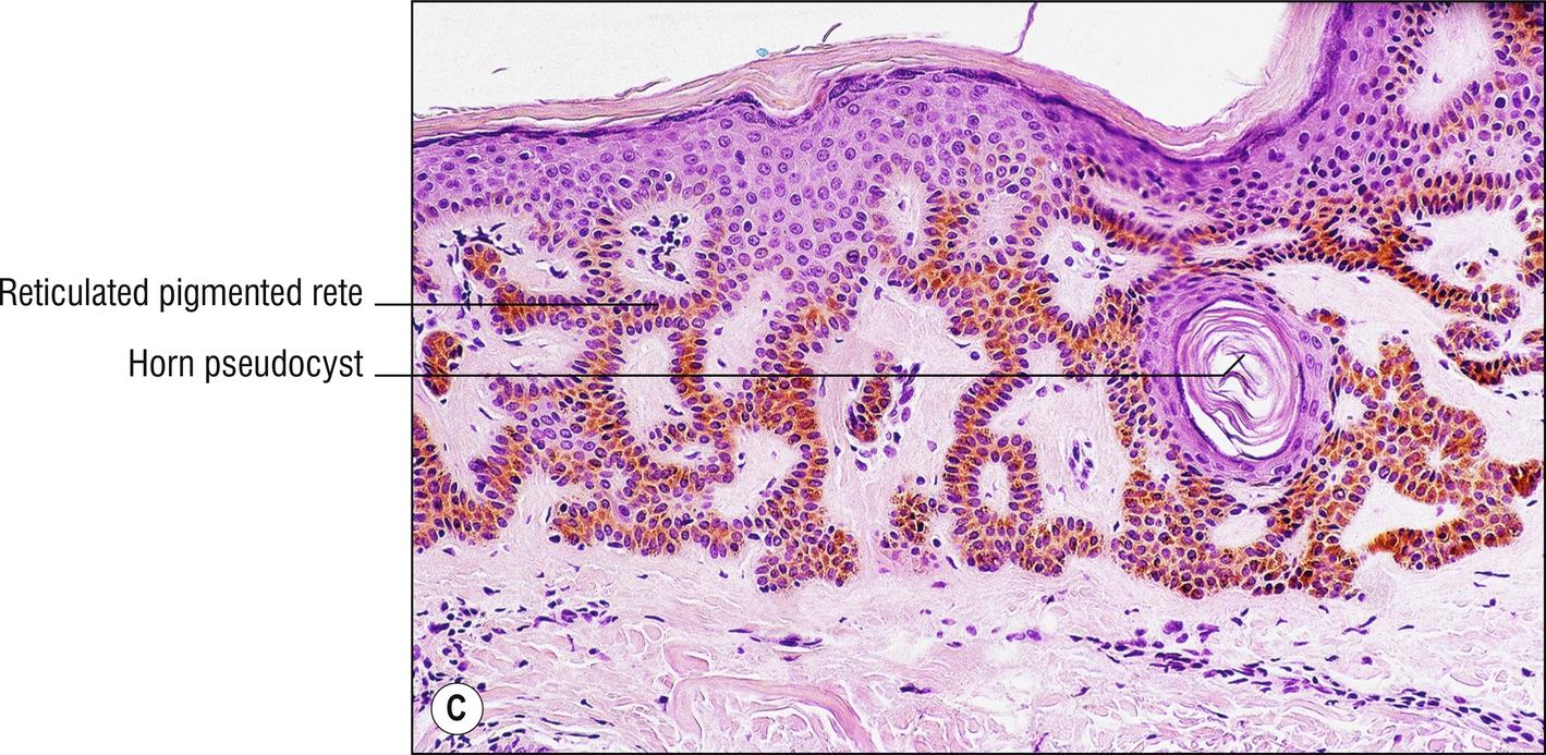 Fig. 18.2, C Seborrheic keratosis (reticulated).