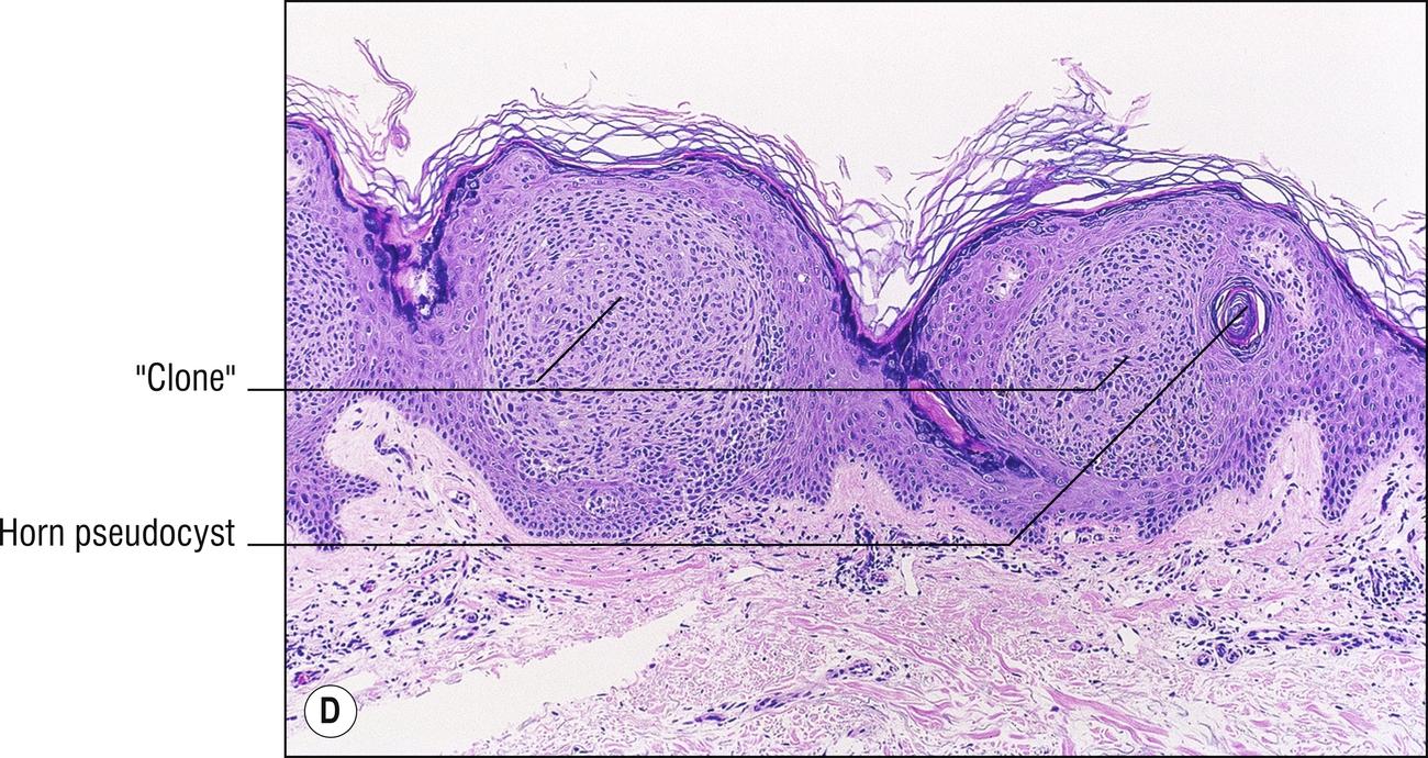 Fig. 18.2, D Seborrheic keratosis (clonal).