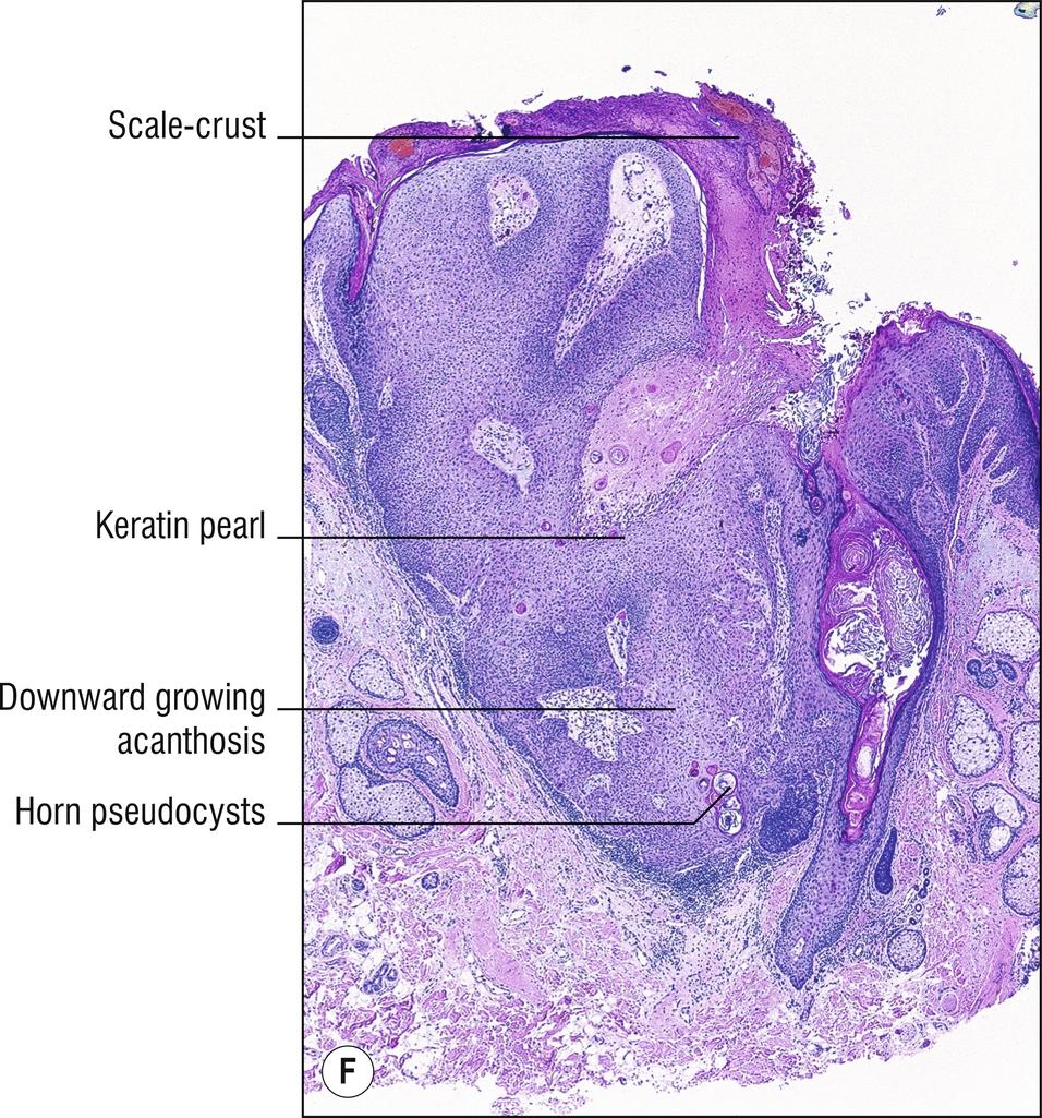 Fig. 18.2, F Inverted follicular keratosis.