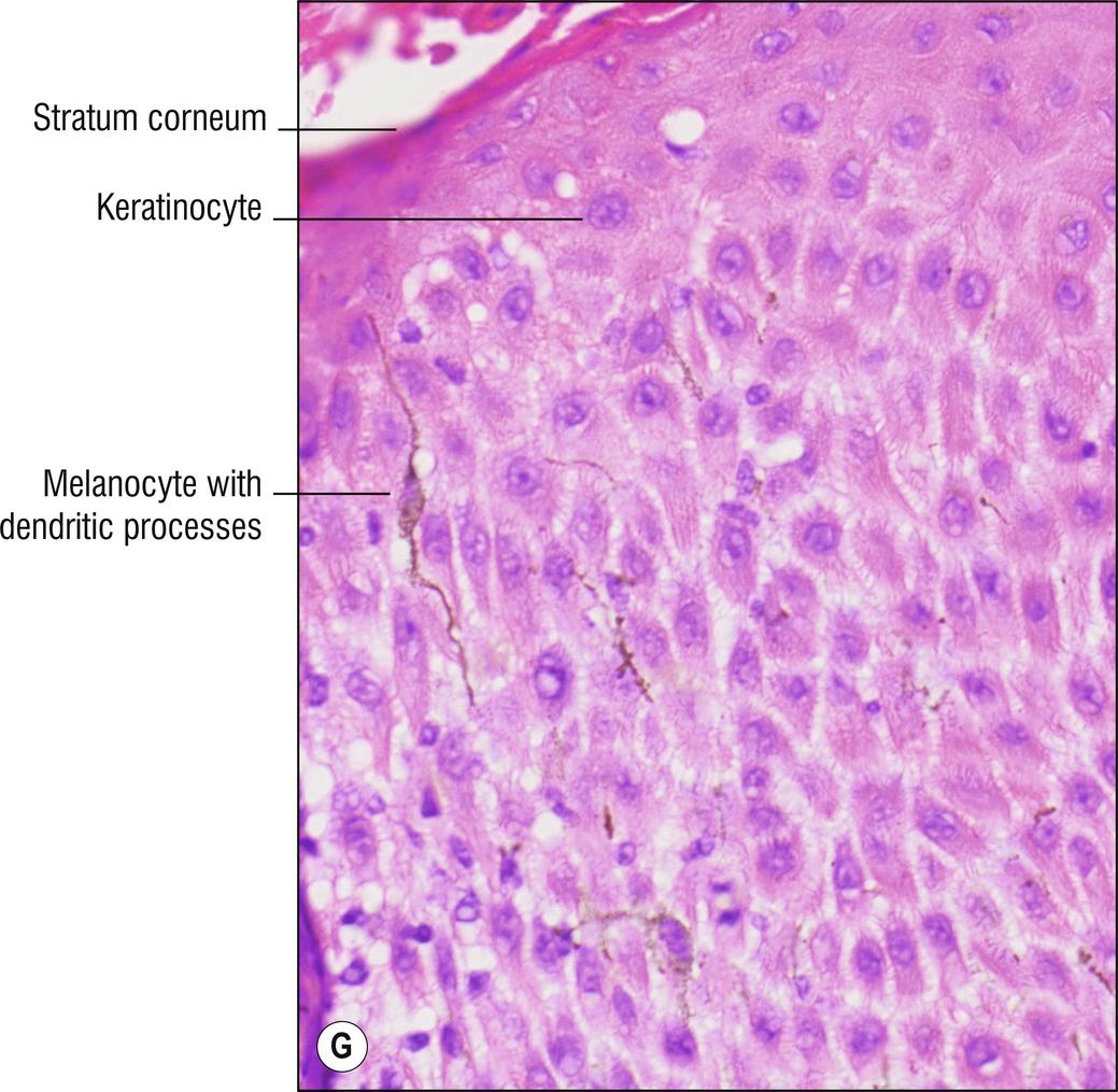 Fig 18.2, G Melanoacanthoma.