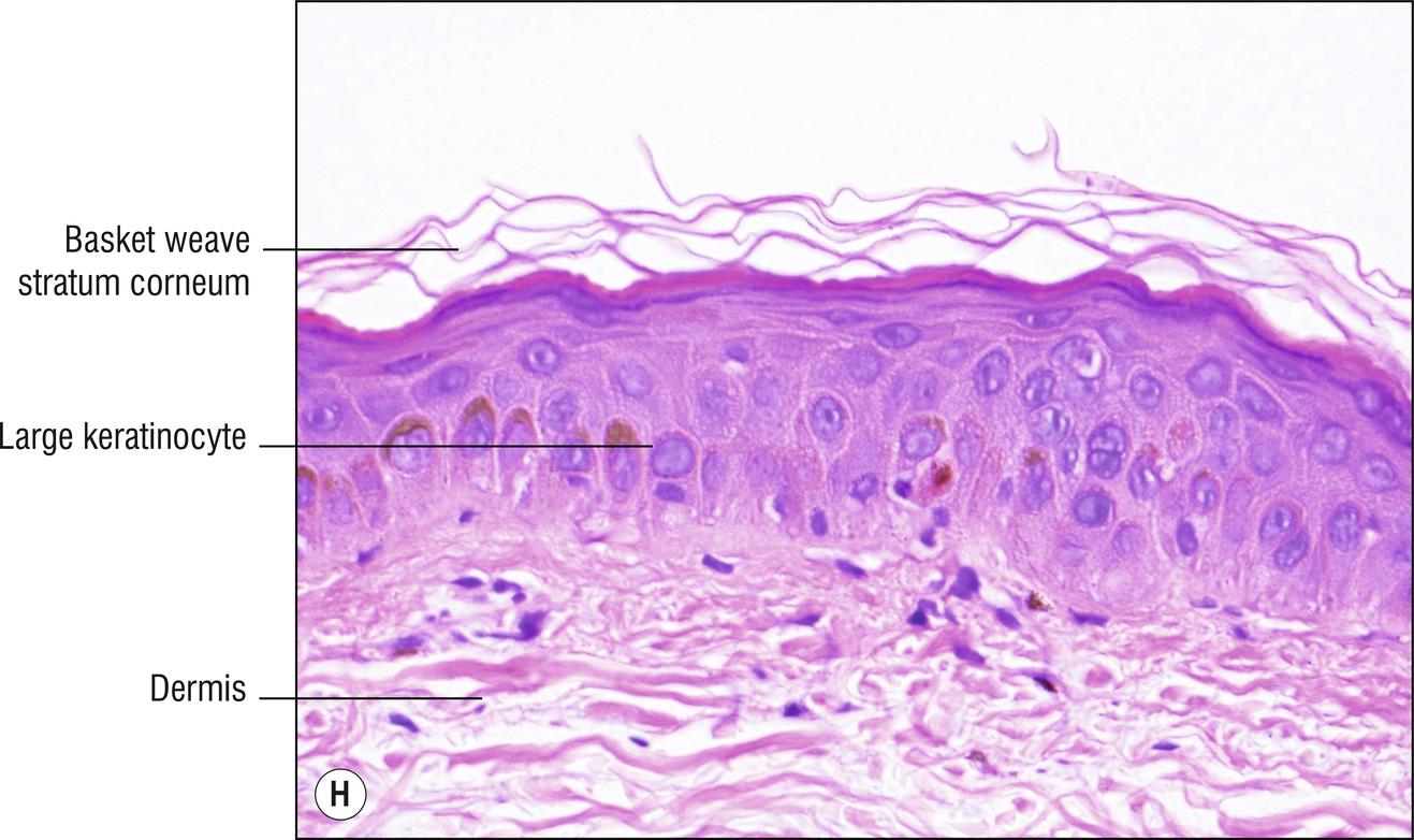 Fig 18.2, H Large cell acanthoma.