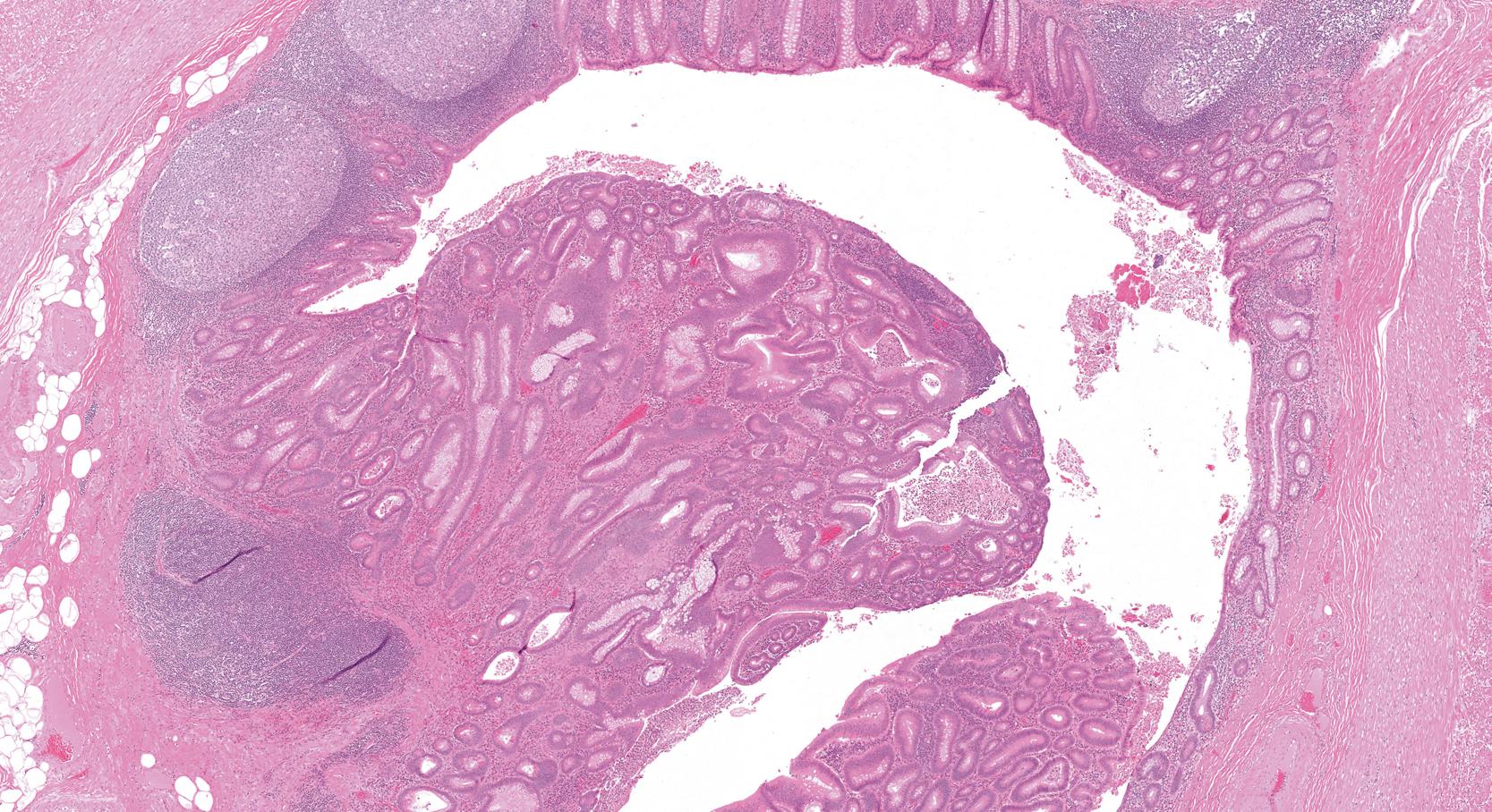 FIGURE 28.1, Tubular adenoma of the appendix. Low-power view shows a polyp projecting into the lumen of the appendix. The polyp shows disordered hyperchromatic glands typical of colorectal tubular adenomas.