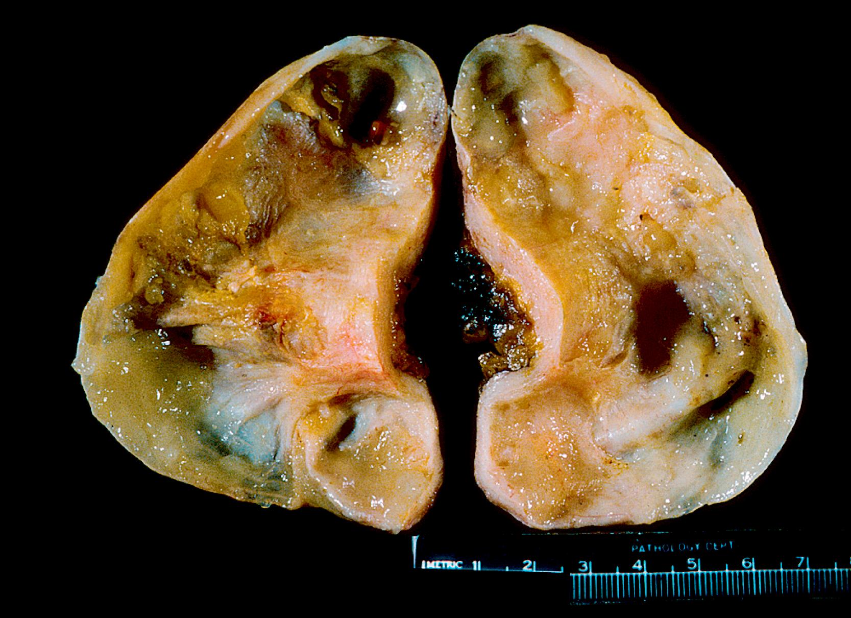 FIGURE 28.2, Gross specimen of a low-grade appendiceal mucinous neoplasm showing cystic transformation of the appendix with marked thickening of the wall.