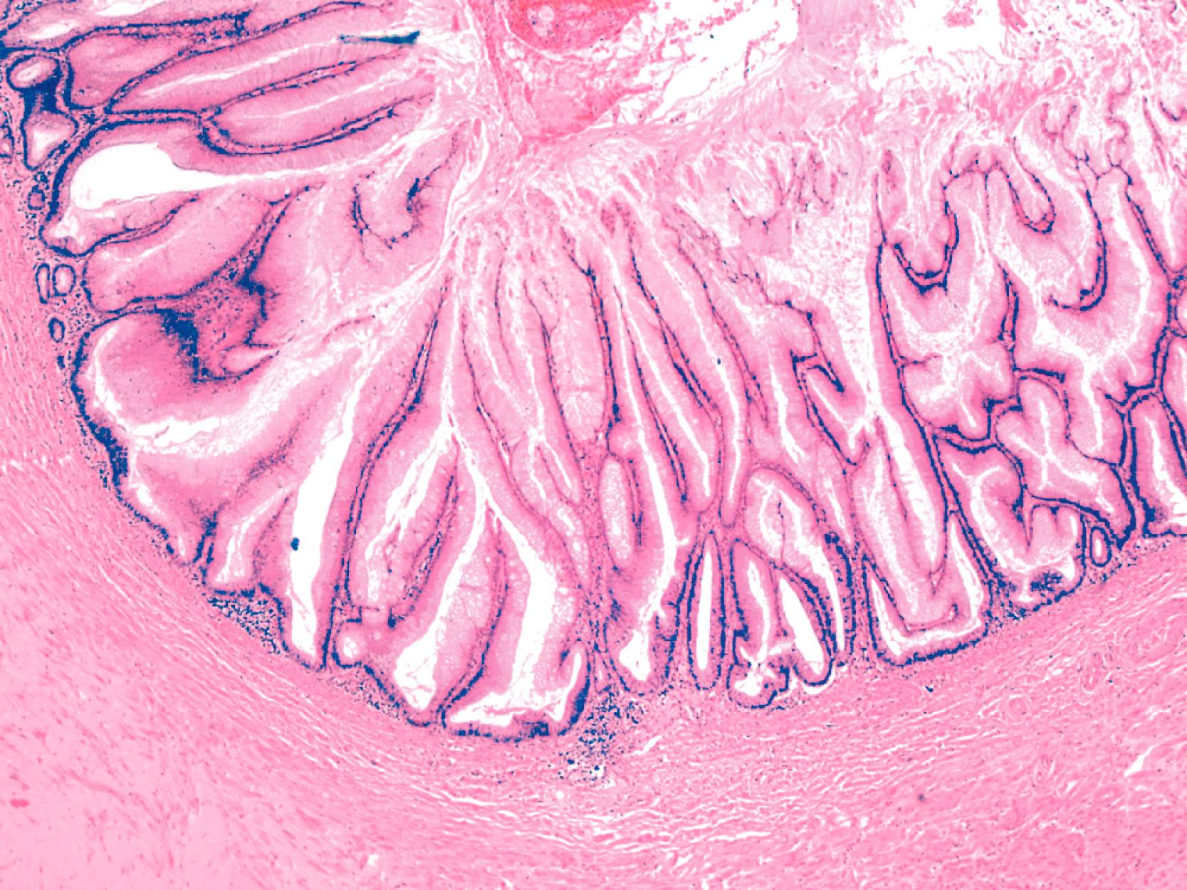 FIGURE 28.3, Low-grade appendiceal mucinous neoplasm.