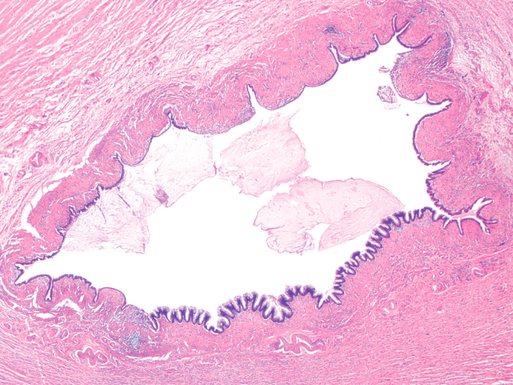 FIGURE 28.5, Low-grade appendiceal mucinous neoplasm.